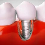 How Long Should You Expect Your Dental Implants To Last?